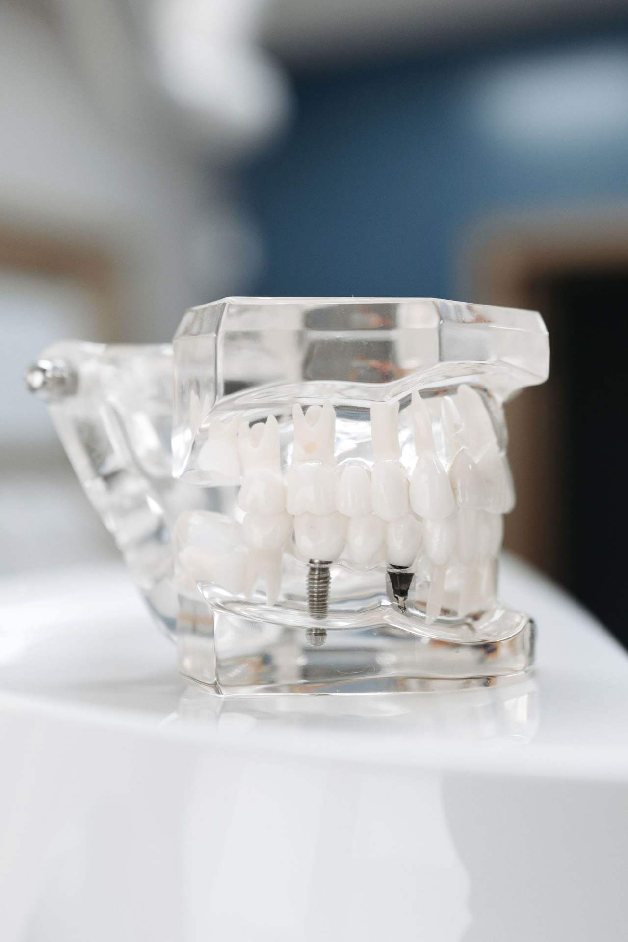 Mô hình hàm nhựa trong suốt cho thấy chân răng và hai trụ implant nằm trong xương hàm