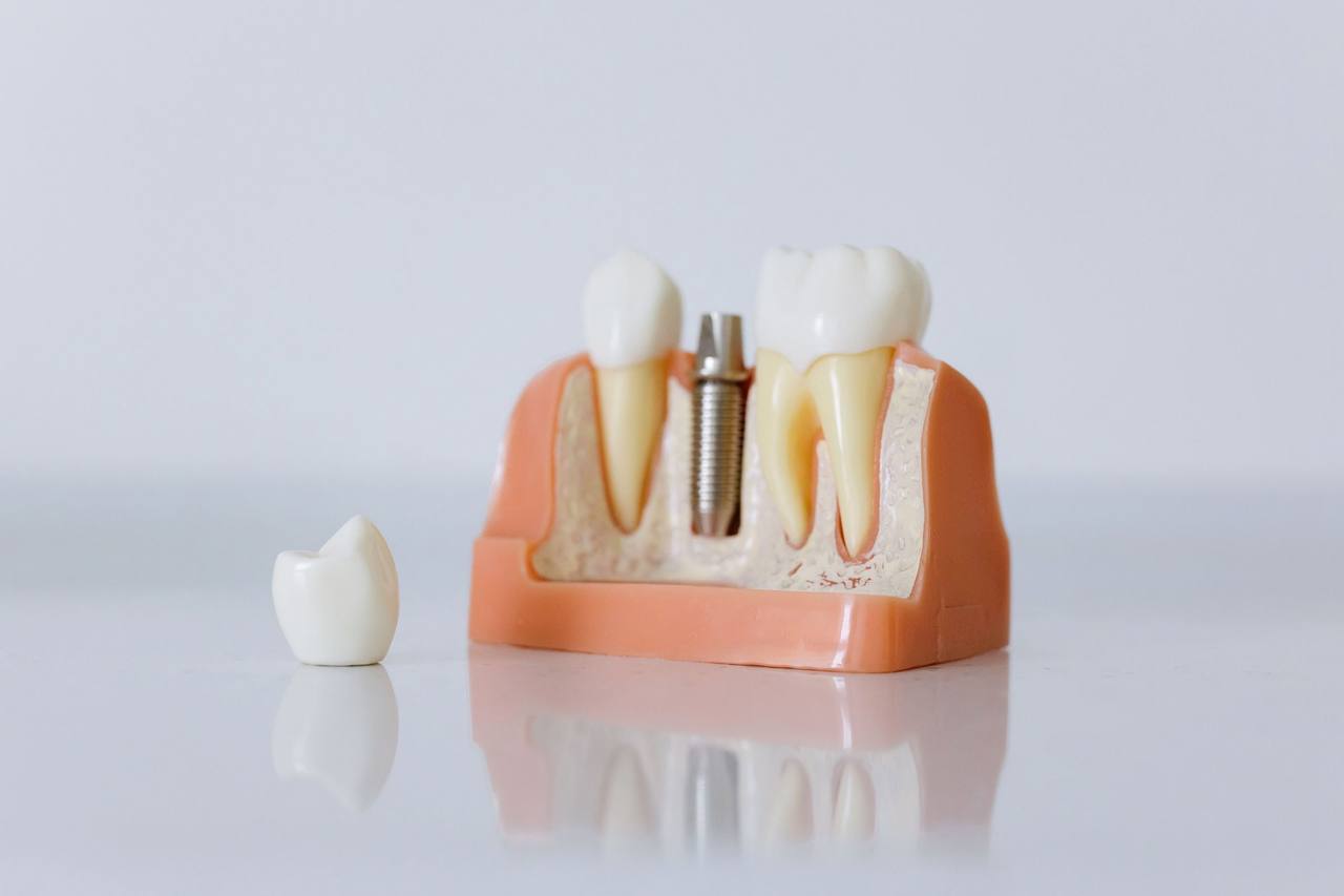 Mô hình hàm cắt ngang có trụ implant chưa gắn mão, chiếc mão răng sứ đặt riêng bên cạnh