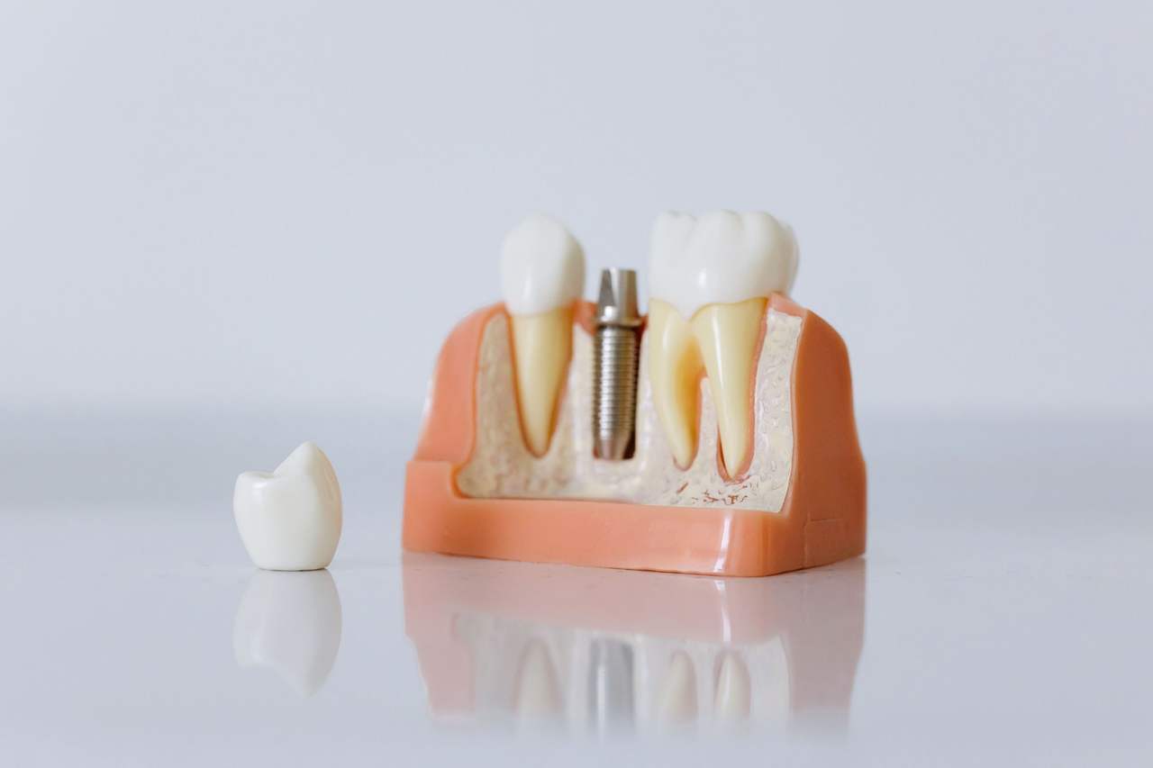 Mô hình hàm cắt ngang có trụ implant chưa gắn mão, chiếc mão răng sứ đặt riêng bên cạnh