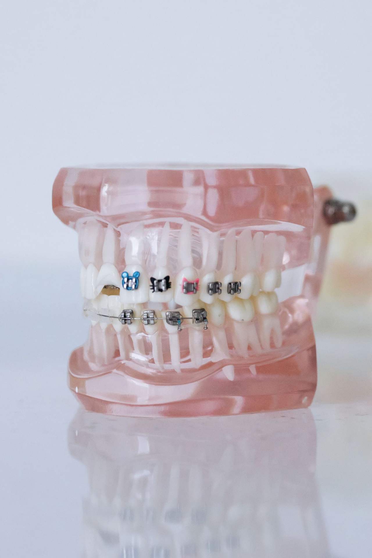 Mô hình hàm răng nhựa trong có gắn mắc cài kim loại và dây cung, đặt trên mặt bàn trắng