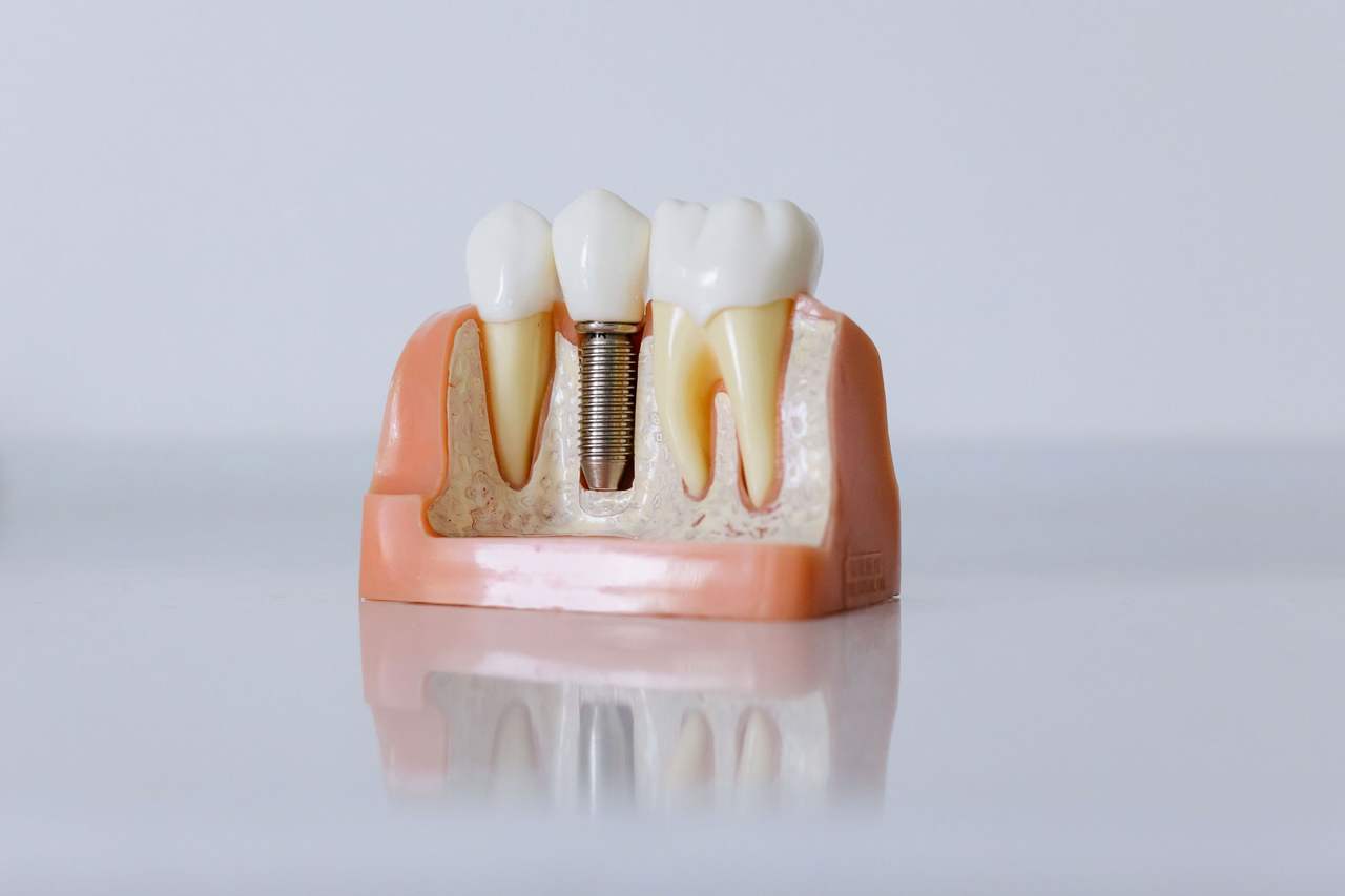 Mô hình cắt ngang hàm với một trụ implant bằng kim loại mang mão răng, nằm giữa hai răng thật có chân răng